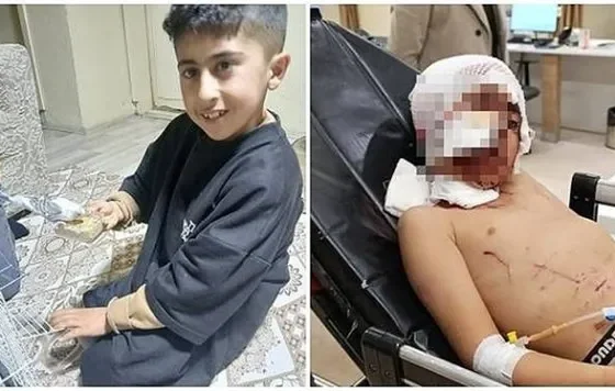 Köpeklerin saldırdığı küçük Murat’ın yaşam savaşı sürüyor