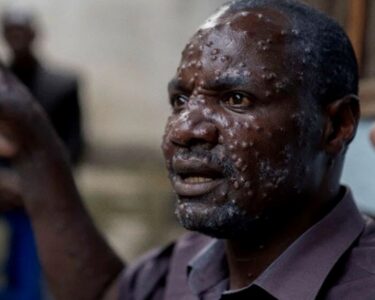 M çiçeği salgınında korkutan artış: Sierra Leone'de virüs patladı - Son Dakika Dünya Haberleri