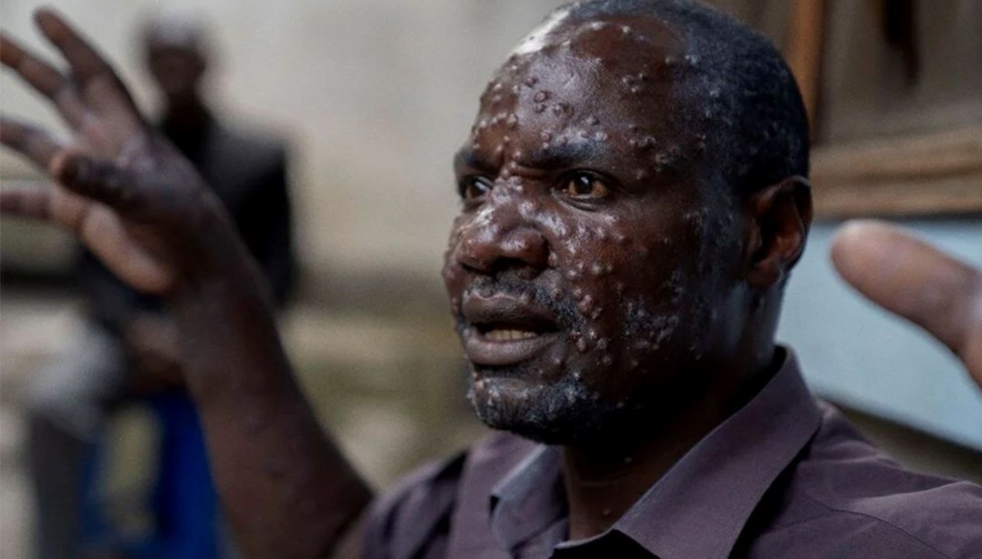 M çiçeği salgınında korkutan artış: Sierra Leone’de virüs patladı – Son Dakika Dünya Haberleri